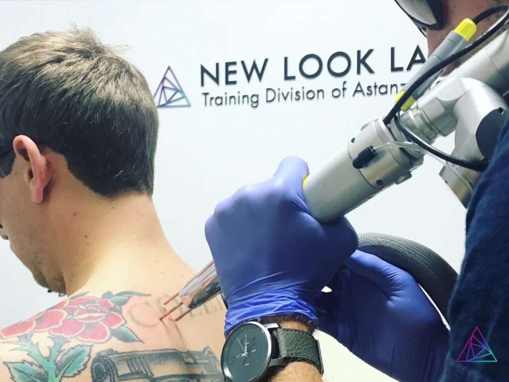 astanza tattoo removal news season one episode six