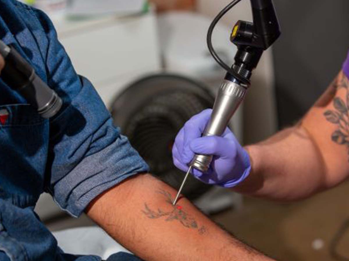 How Much Does a Tattoo Removal Laser Cost?