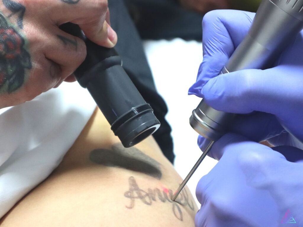most-Frequently-asked-questions-about-laser-tattoo-removal-training