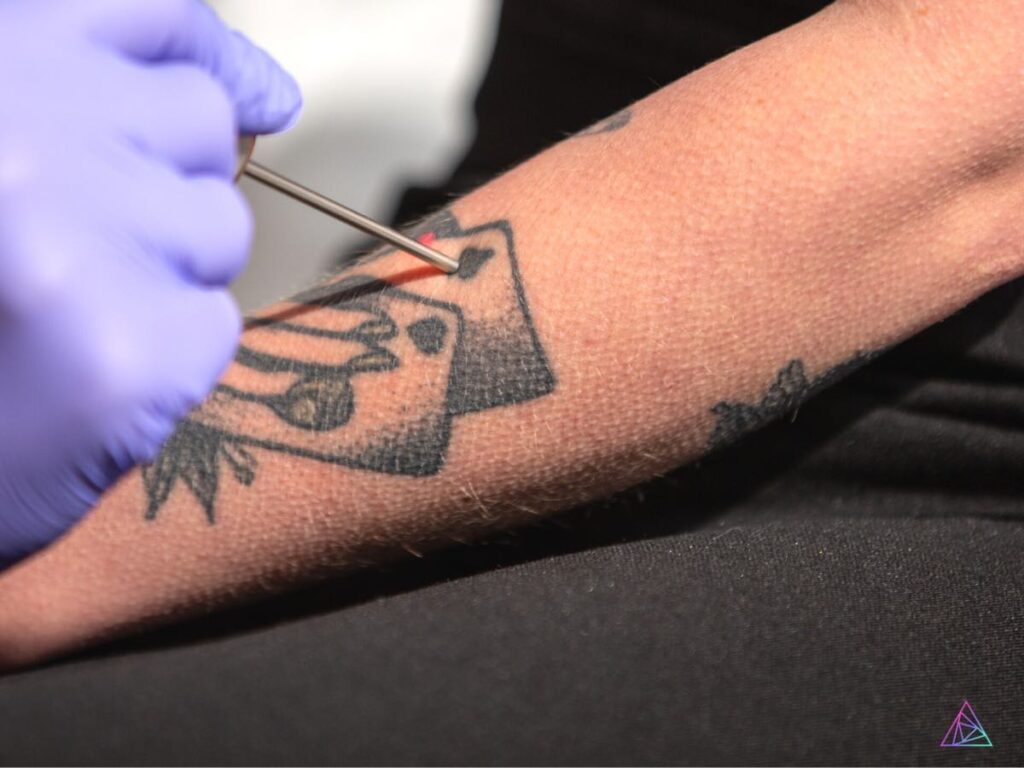 astanza tattoo removal news episode 12 season 1