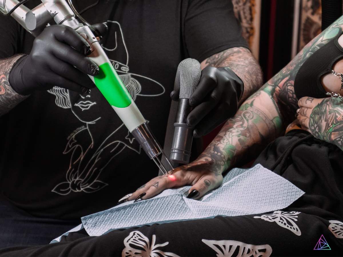 Triple Wavelength Lasers for Full-Color Spectrum Tattoo Removal