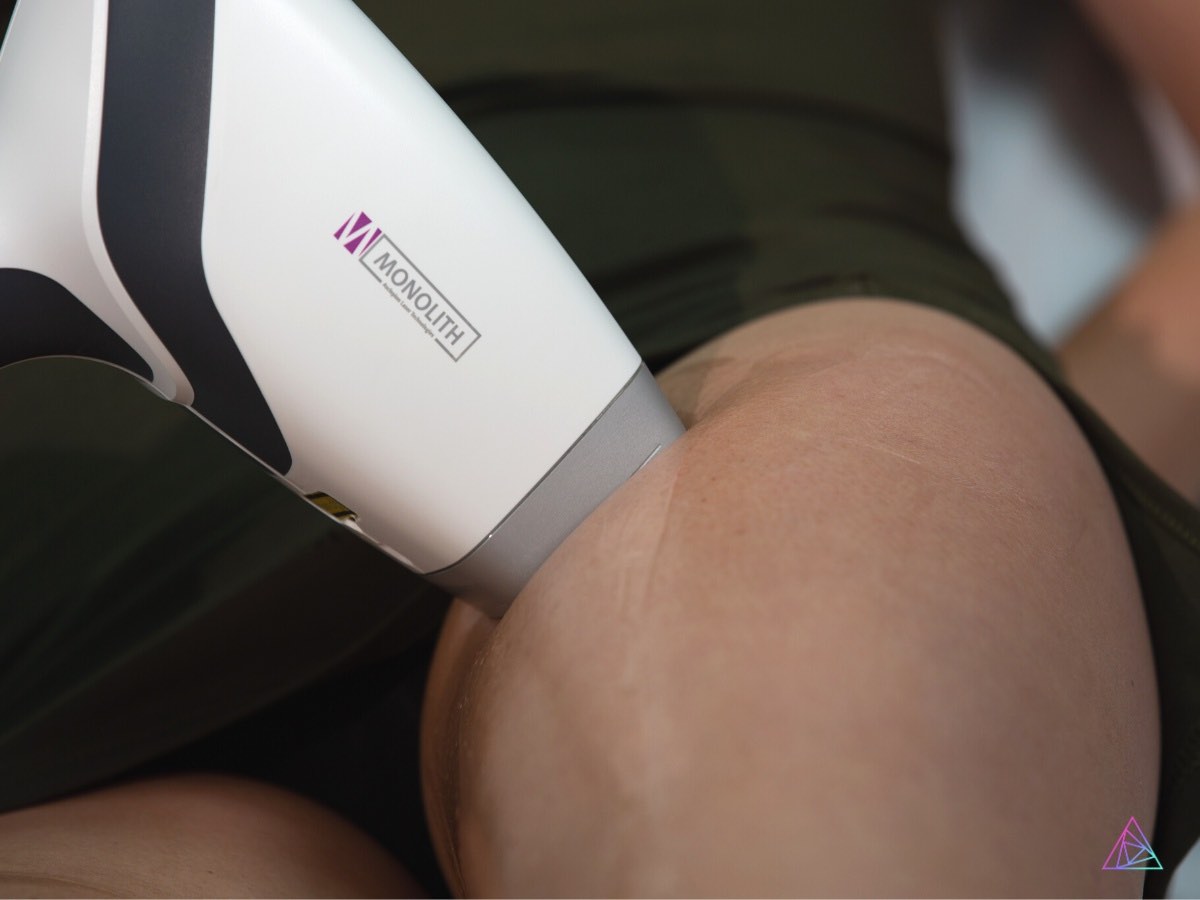 What Makes Diode Hair Removal Lasers the Most Effective