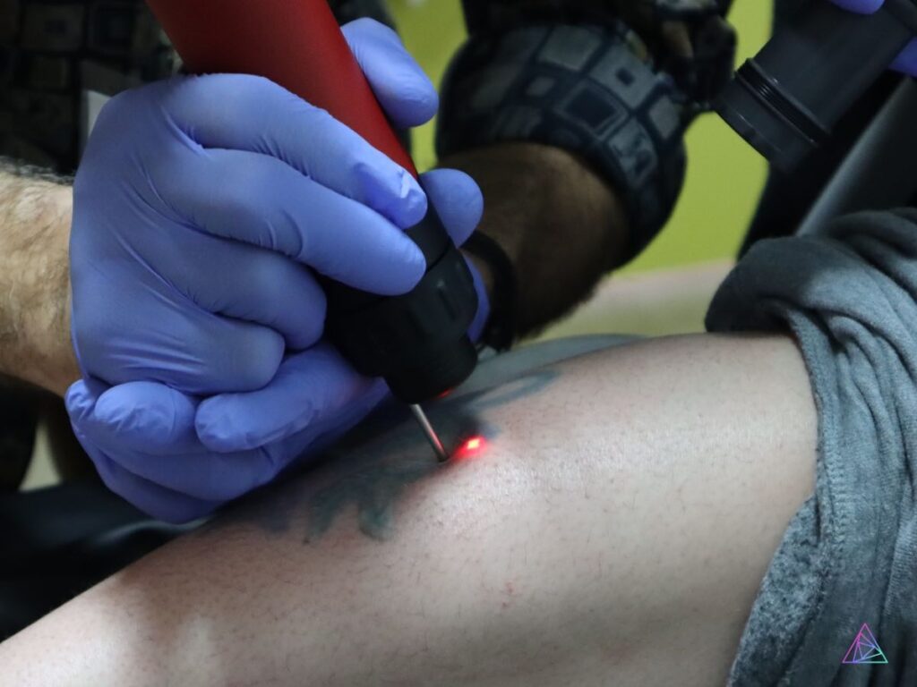 Calling All Entrepreneurs: The Best Tattoo Removal Laser