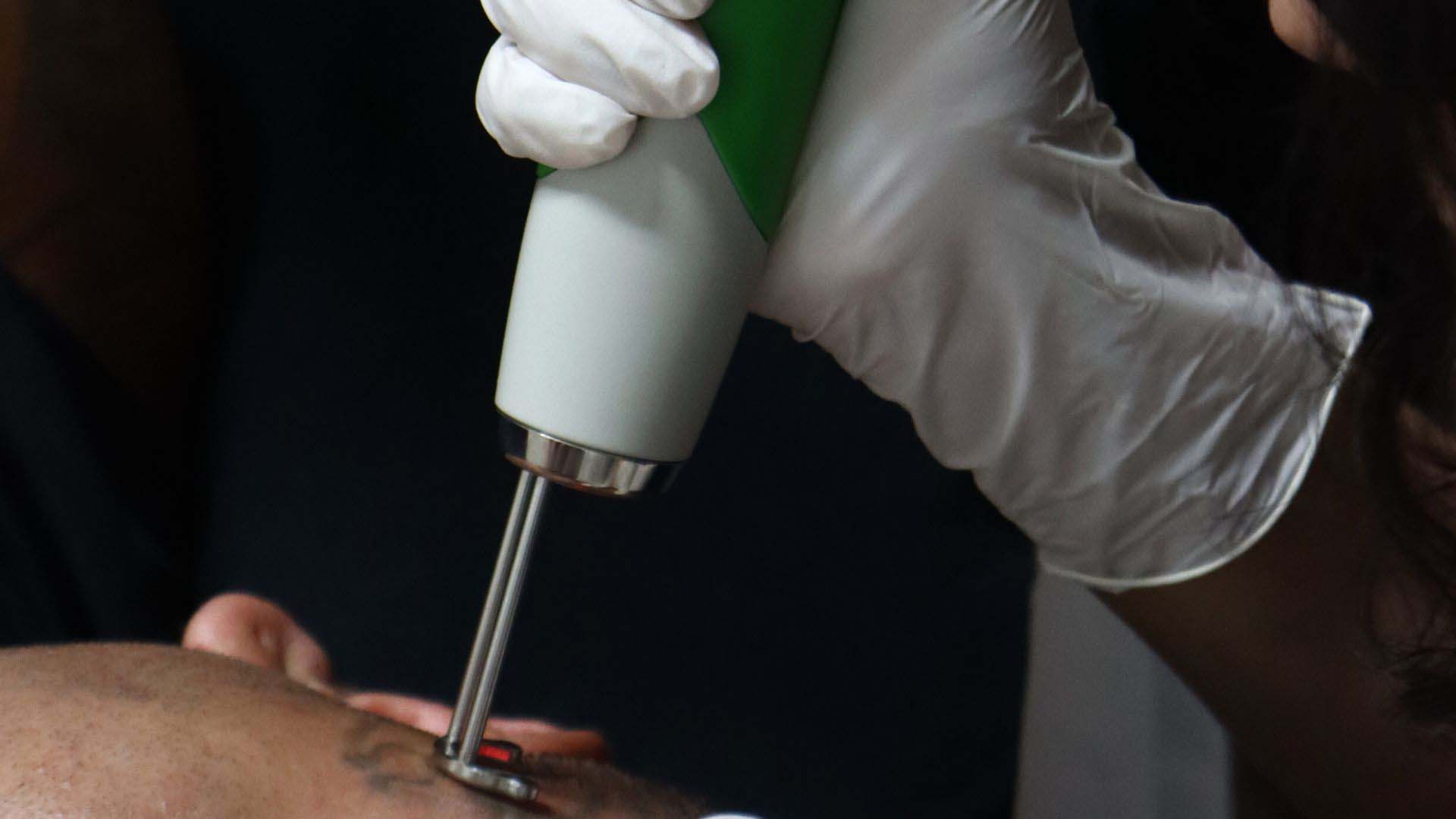 5 Reasons to Start a Laser Tattoo Removal Business
