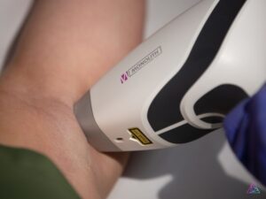 questions about laser hair