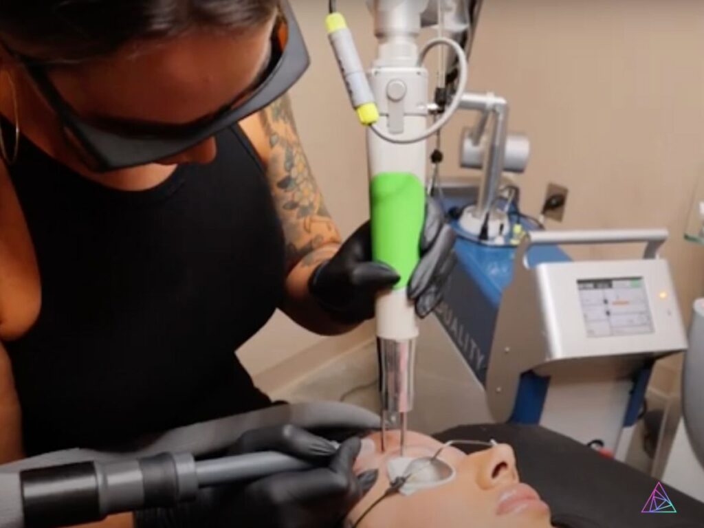 how laser tattoo removal