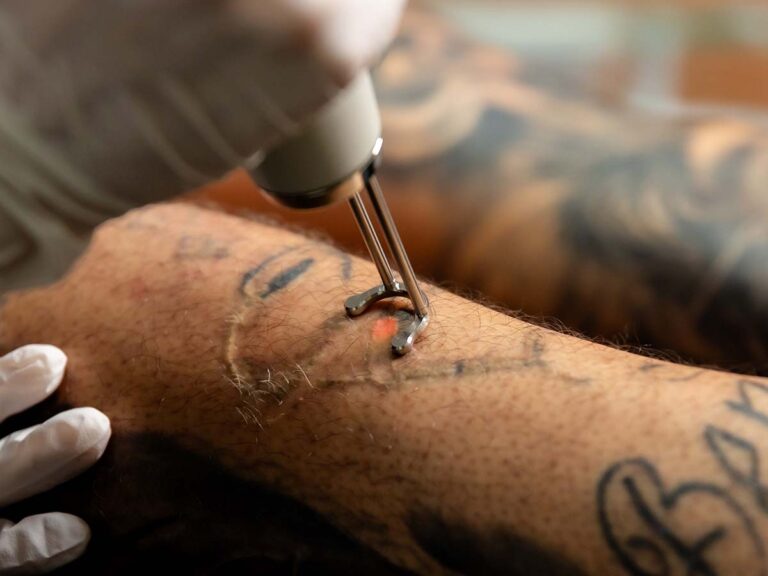 Astanza Laser Tattoo Removal