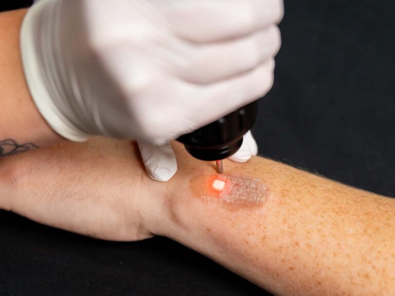 Pigmentation Treatment