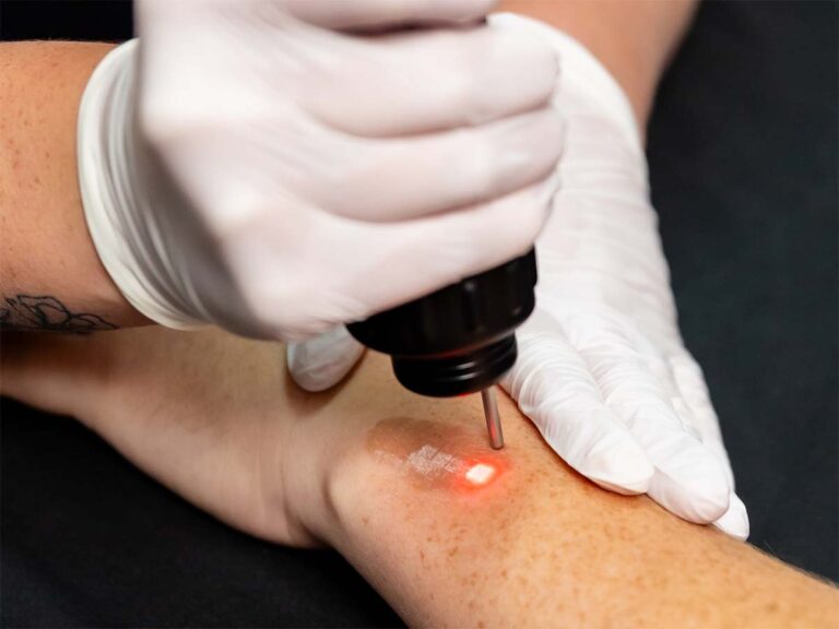 Pigmentation Treatment