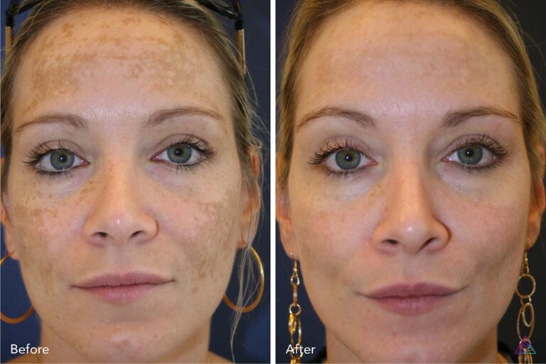 Skin Resurfacing Pic - Skin Resurfacing Page