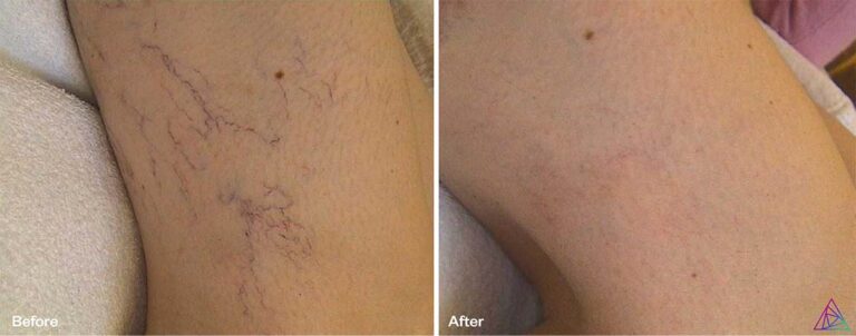 Vascular Lesions Treatment