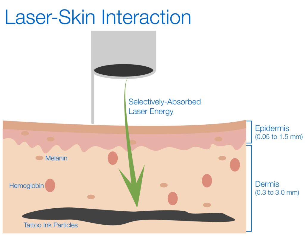 Laser Skin Interaction tattoo removal astanza laser