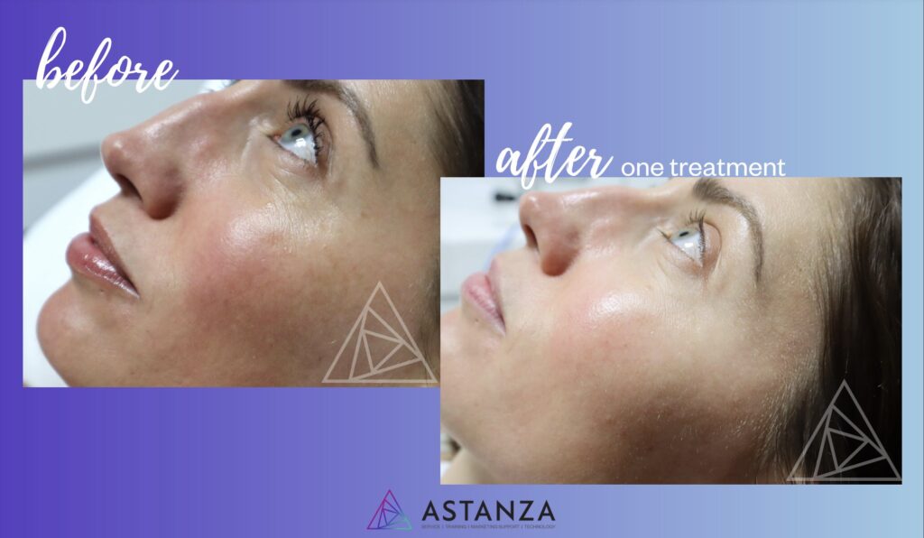 before and after results melasma quadrostar pro yellow