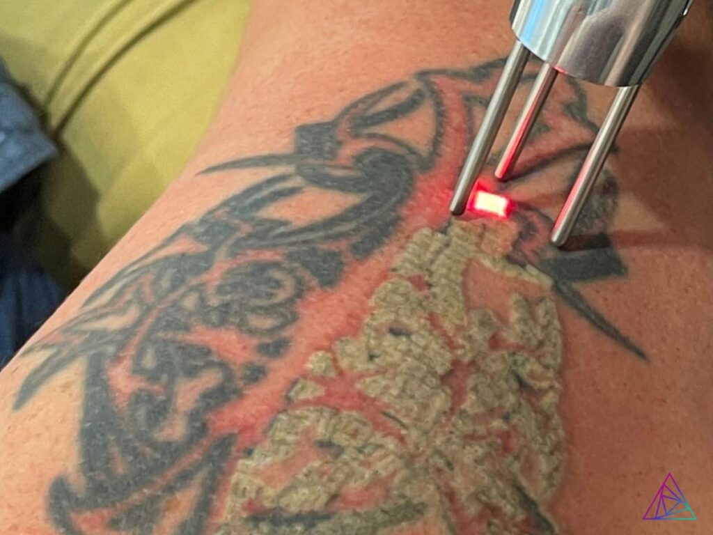 Astanza Tattoo Removal News Season 2 Episode 12