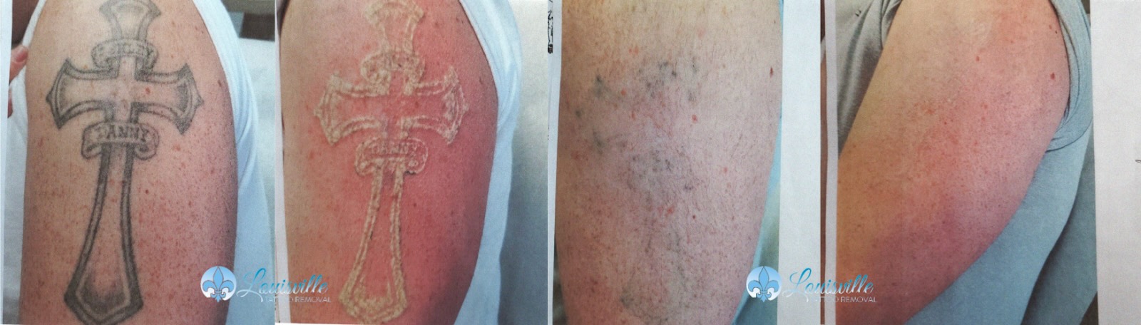 2023-Before-and-After-Contest-Best-Completed-Tattoo-Removal-Louisville-Tattoo-Removal-Winner