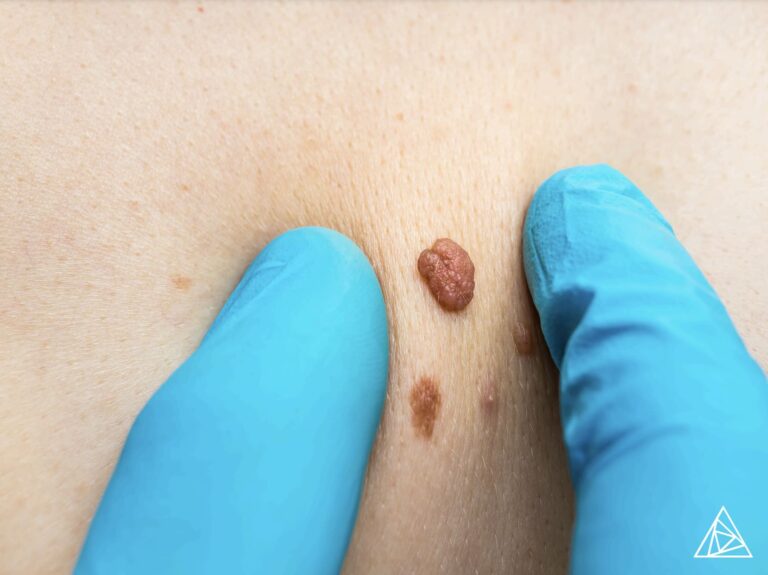 BLOG-Offering-Advanced-Laser-Services-for-Pigmentation