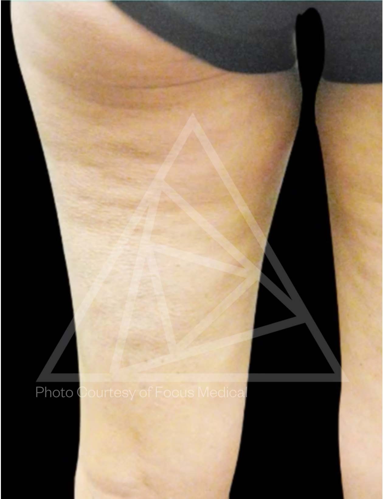Carbon Wave Patch Before - Legs 1