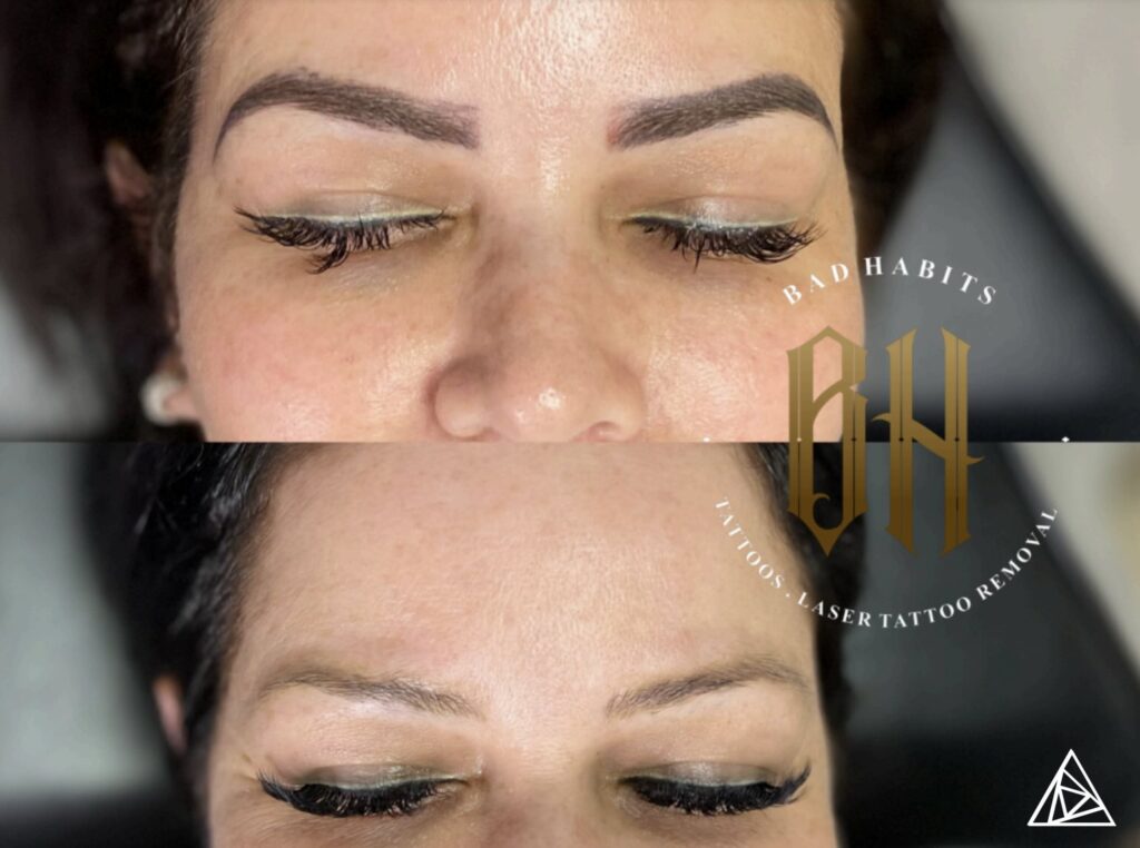 BLOG-Permanent-Makeup-Removal-Using-Aesthetic-Laser-Technology