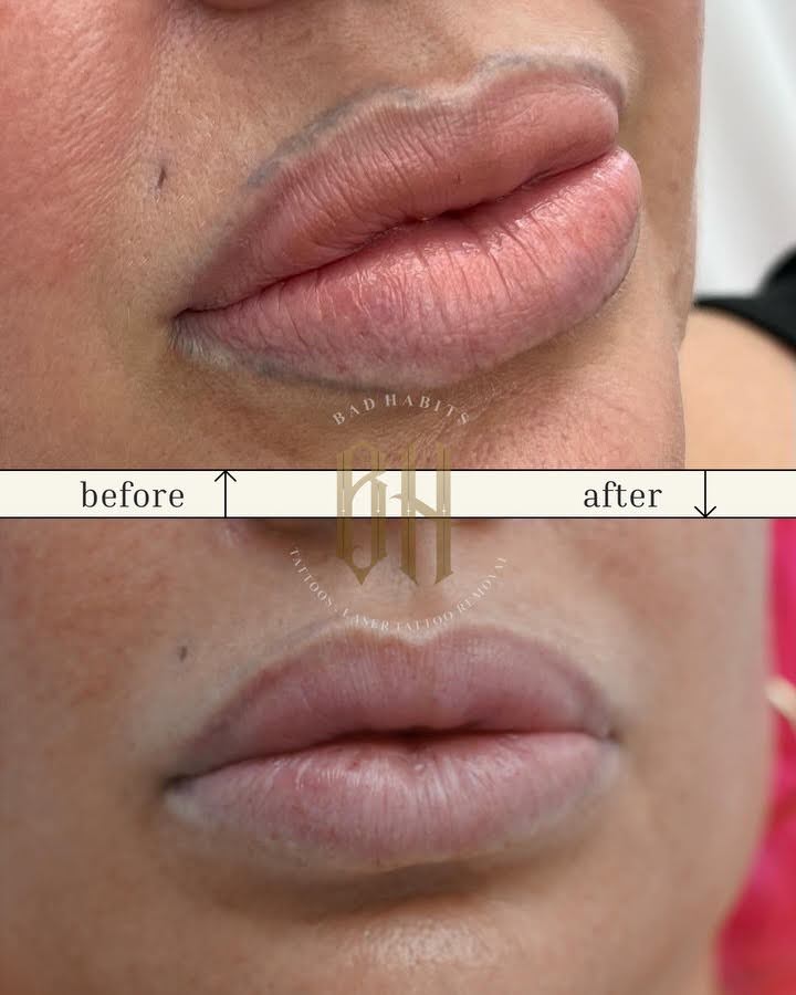 Bad-Habits-Lip-Liner-Permanent-Makeup-Removal-Before-and-After
