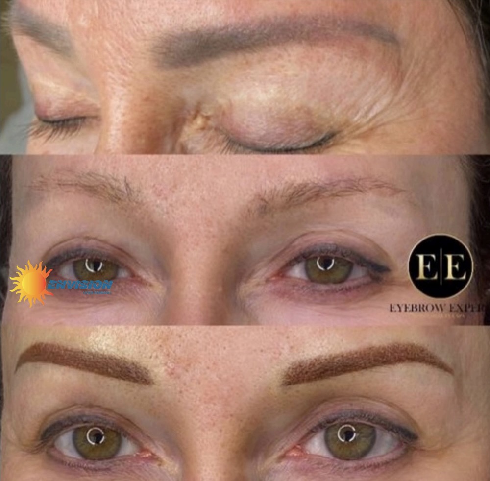 Envision-Eyebrow-Permanent-Makeup-Removal-Before-and-After