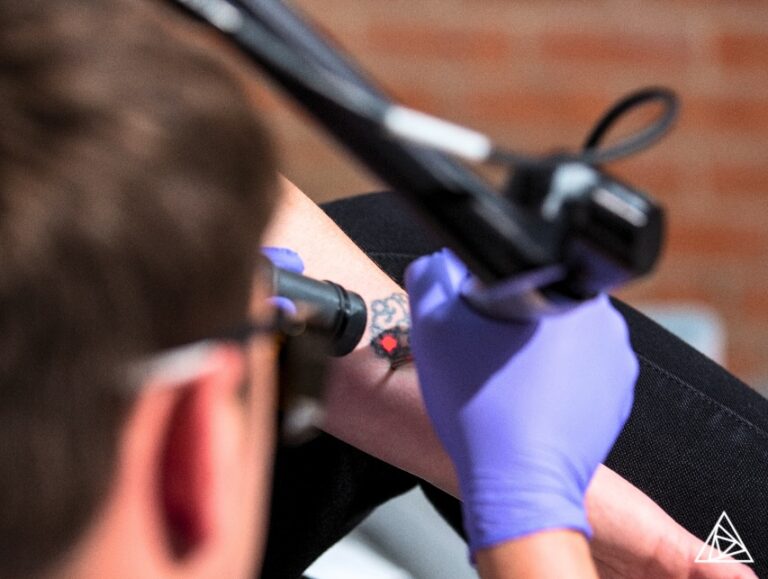 Tattoo Removal Technology for The Best Results