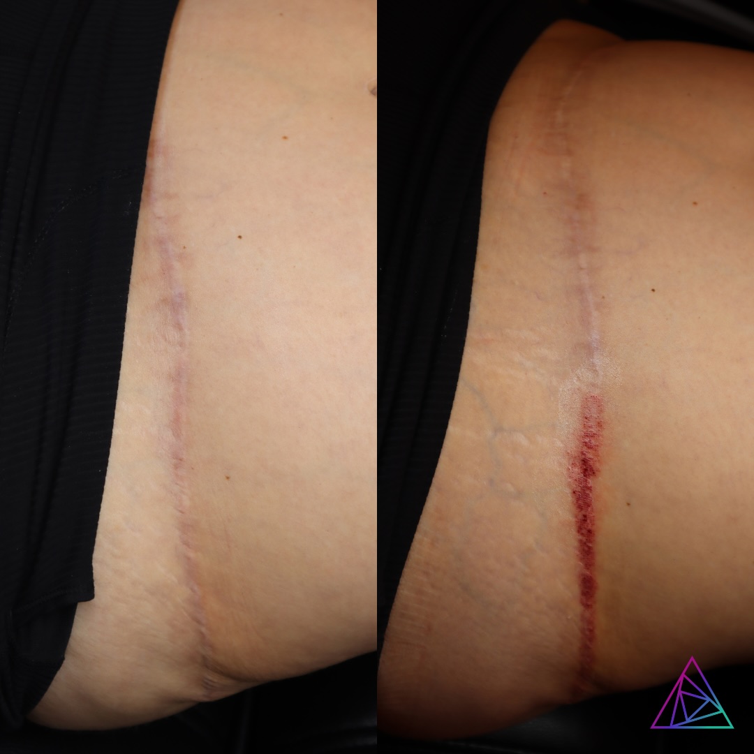laser-skin-resurfacing-scar-revision-astanza-duality-signature-laser