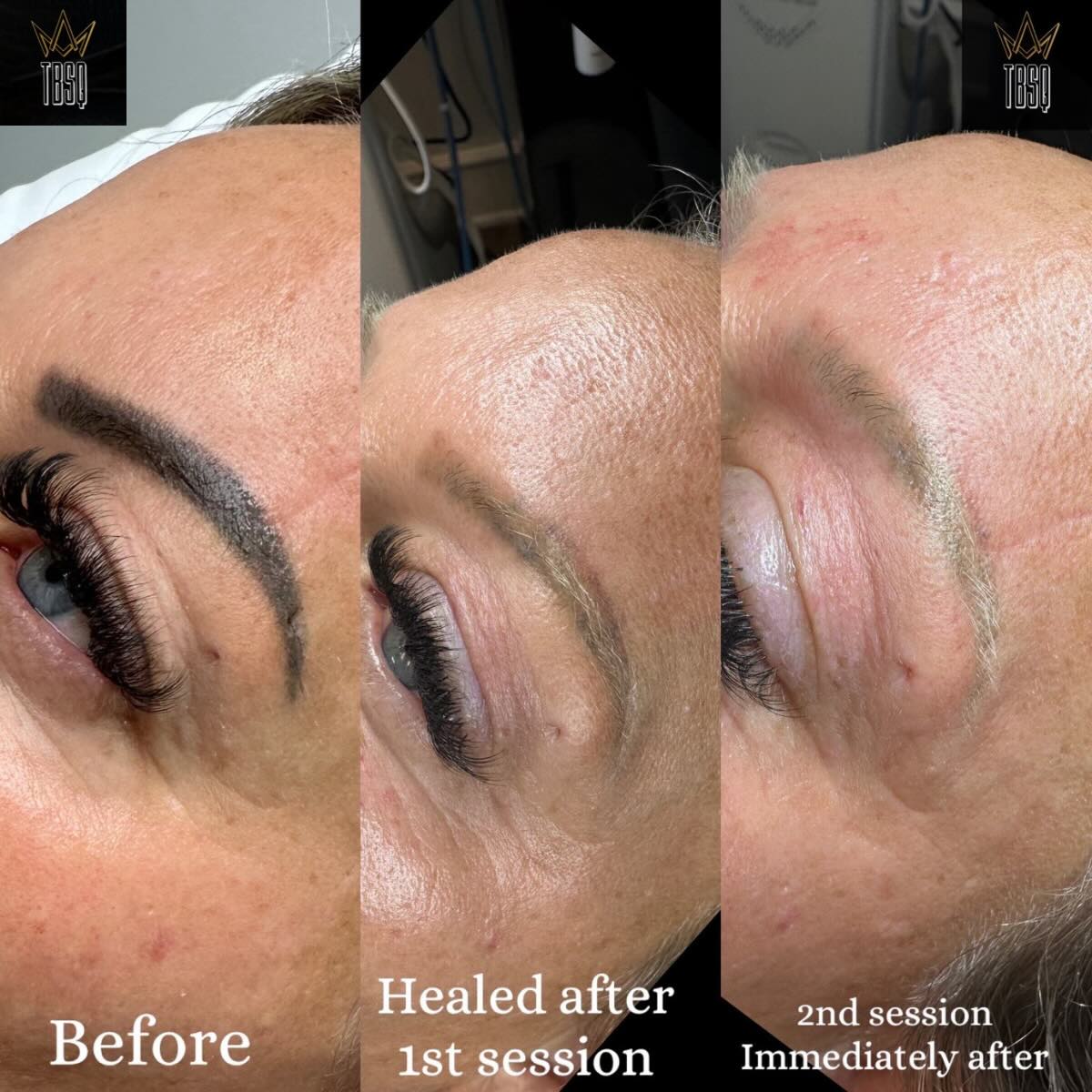 permanent-makeup-removal-the-brow-shaping-queen-astanza-duality-signature-laser