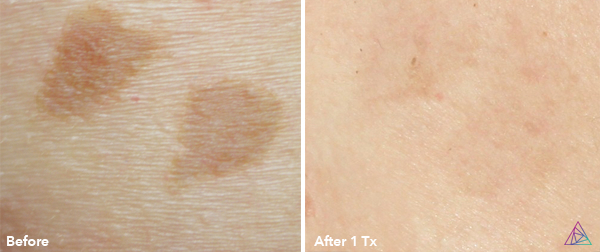 pigmentation-correction-astanza-duality-signature-laser