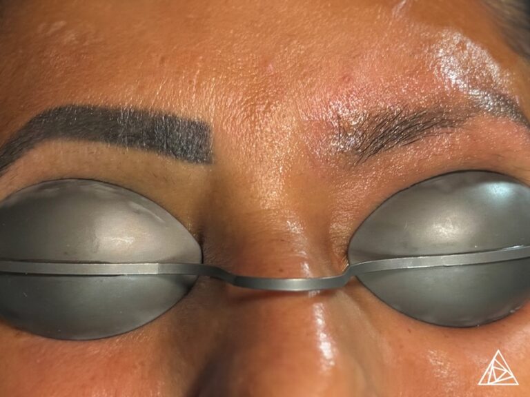 permanent makeup removal