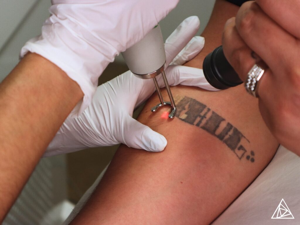 Adding Laser Tattoo Removal Services to a Non-Profit