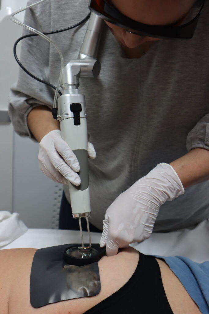 Cellulite Treatment Carbon Wave