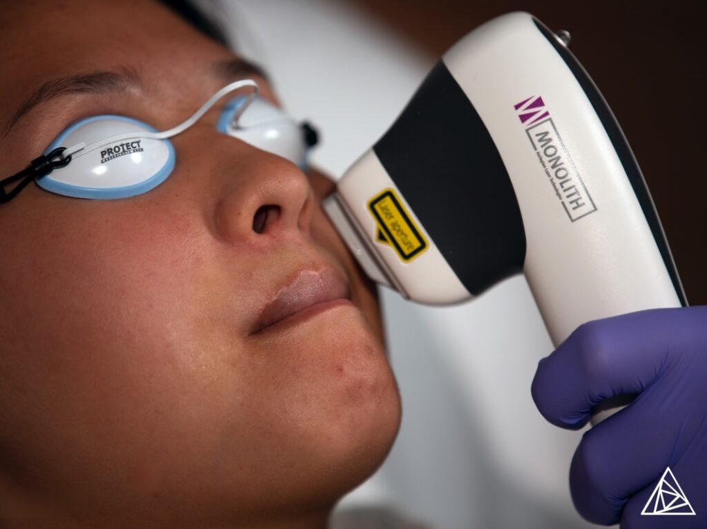 Lip Laser Hair Removal with