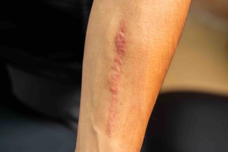 Laser Scar Reduction Treatment - After Result