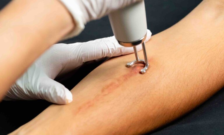 Laser Scar Reduction Treatment