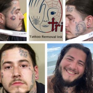 Tattoo Removal Ink Winner