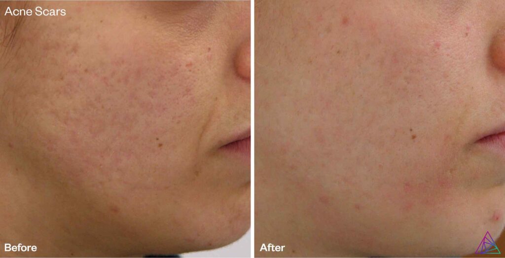 Acne Scars Treatment Before and After