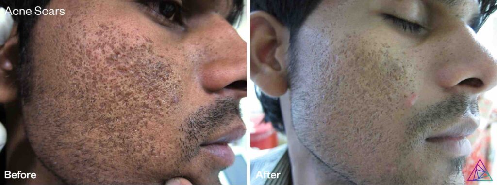 Acne Scars Before and After