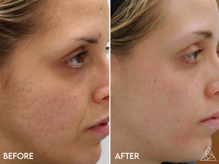 Acne Scar Treatment