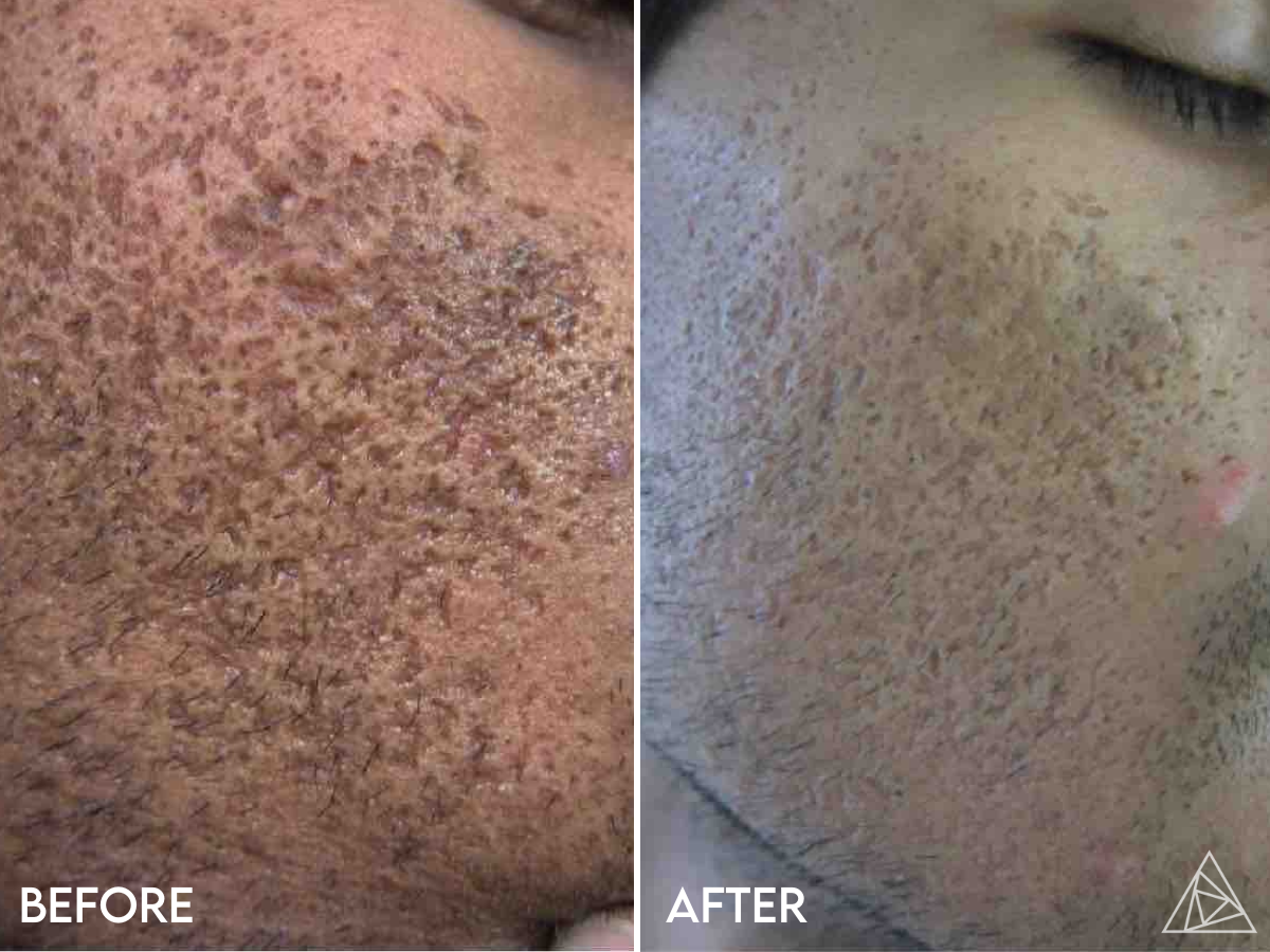 Acne Scars Treament Before & After