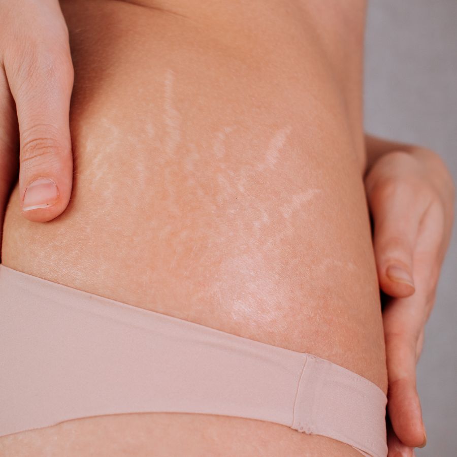 stretch marks photo on hip