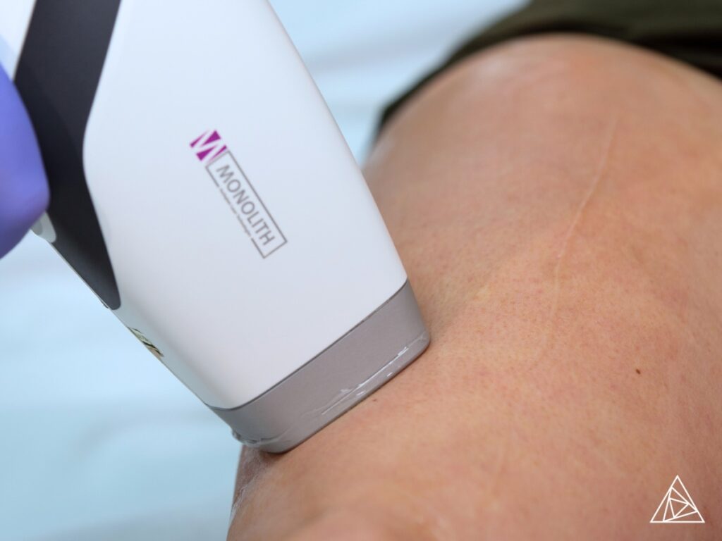 Hair Removal Laser for the Best Hair Removal Results