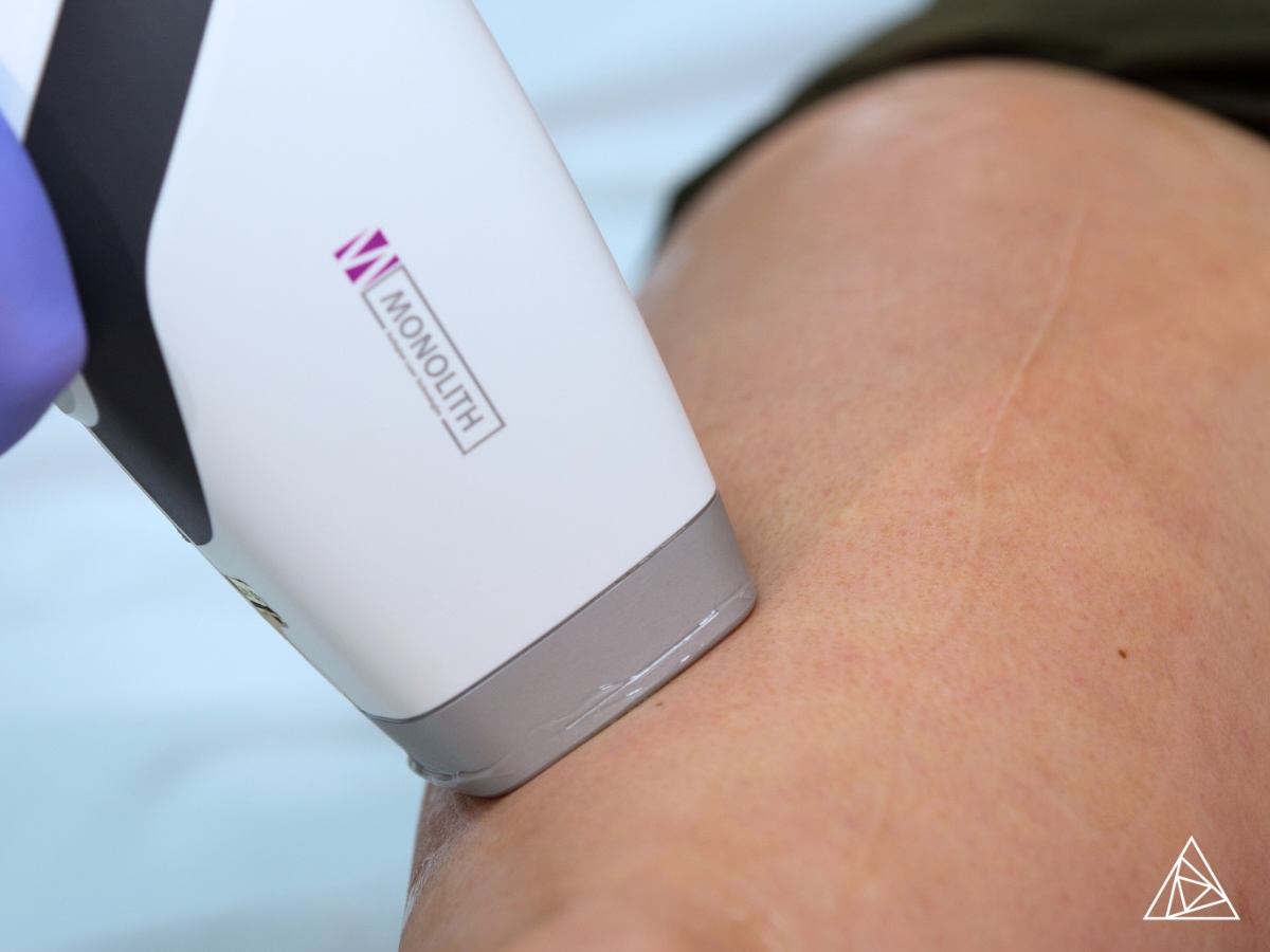 BLOG - Hair Removal Laser for the Best Hair Removal Results