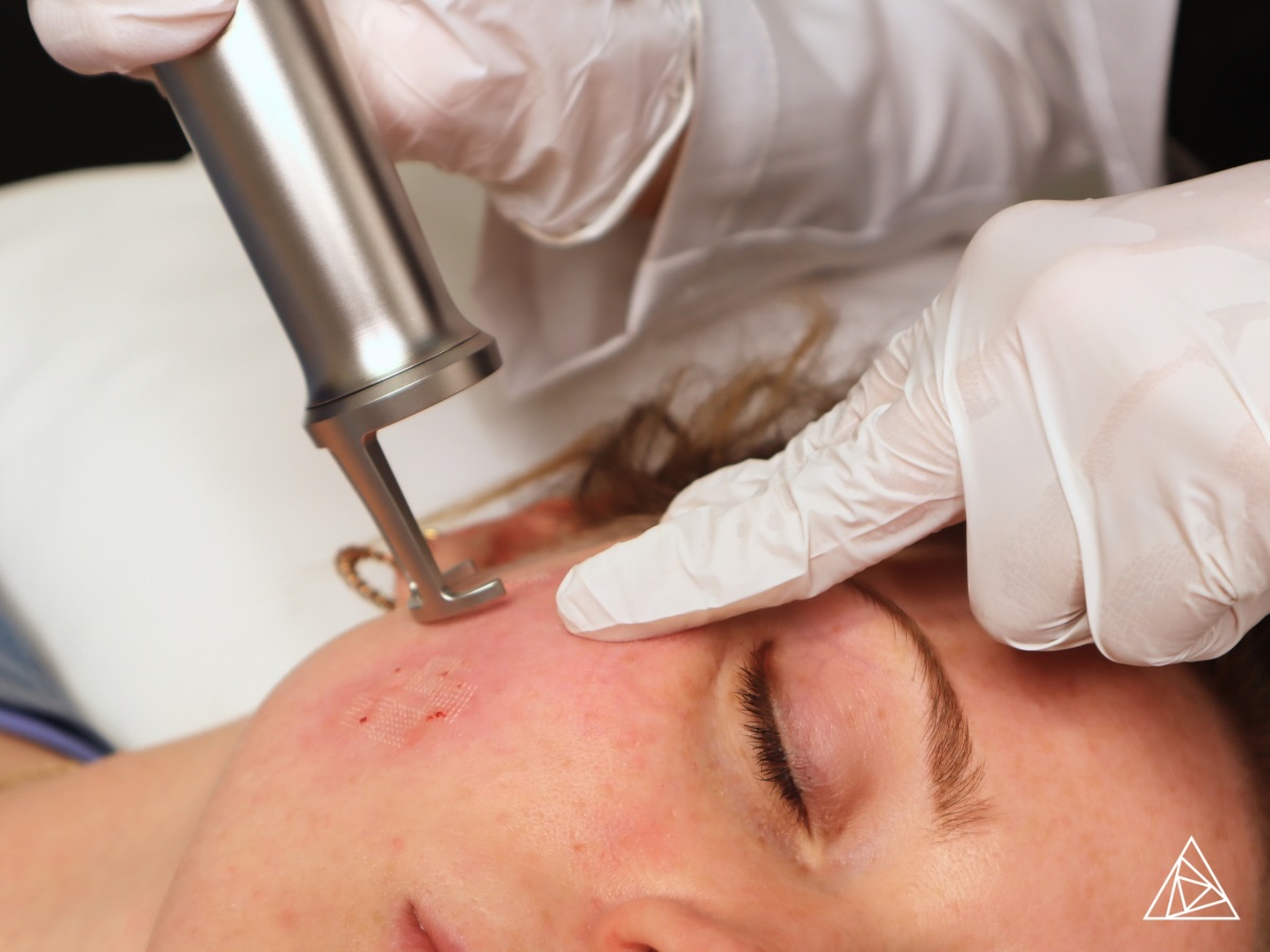 BLOG - Science Behind the Glow: Erbium YAG Lasers