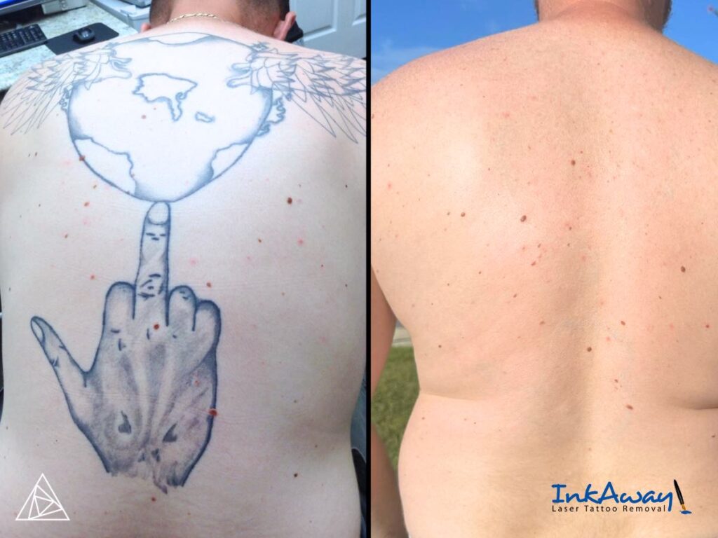 Before and After Laser Tattoo Removal with the Astanza Trinity