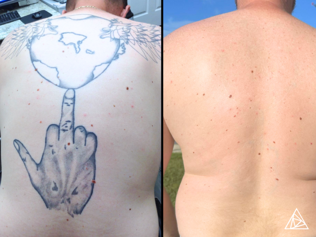 Before and After Laser Tattoo Removal with the Astanza Trinity