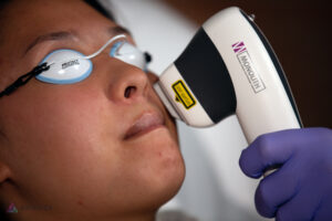 Lips Laser Hair Removal