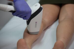XL handpiece laser hair removal