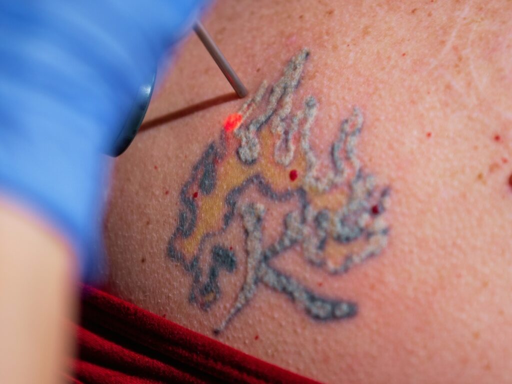 Promoting Your Laser Tattoo Removal Business BLOG