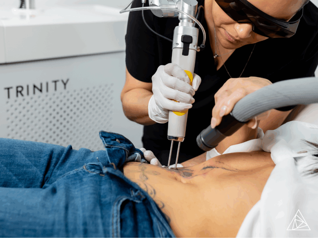 A tattoo removal laser practitioner removing a full-spectrum tattoo on the abdomen using the Astanza Trinity. The tattoo is an outline of a skull with colorful splotches around it.