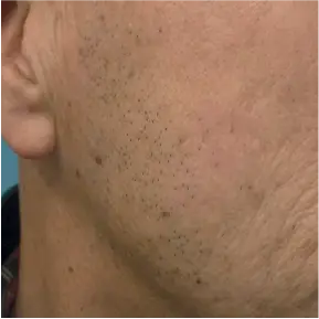 After treatment